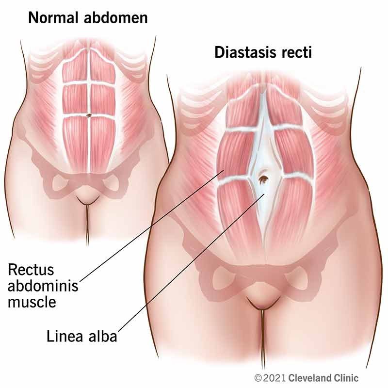 Diastasis Recti
