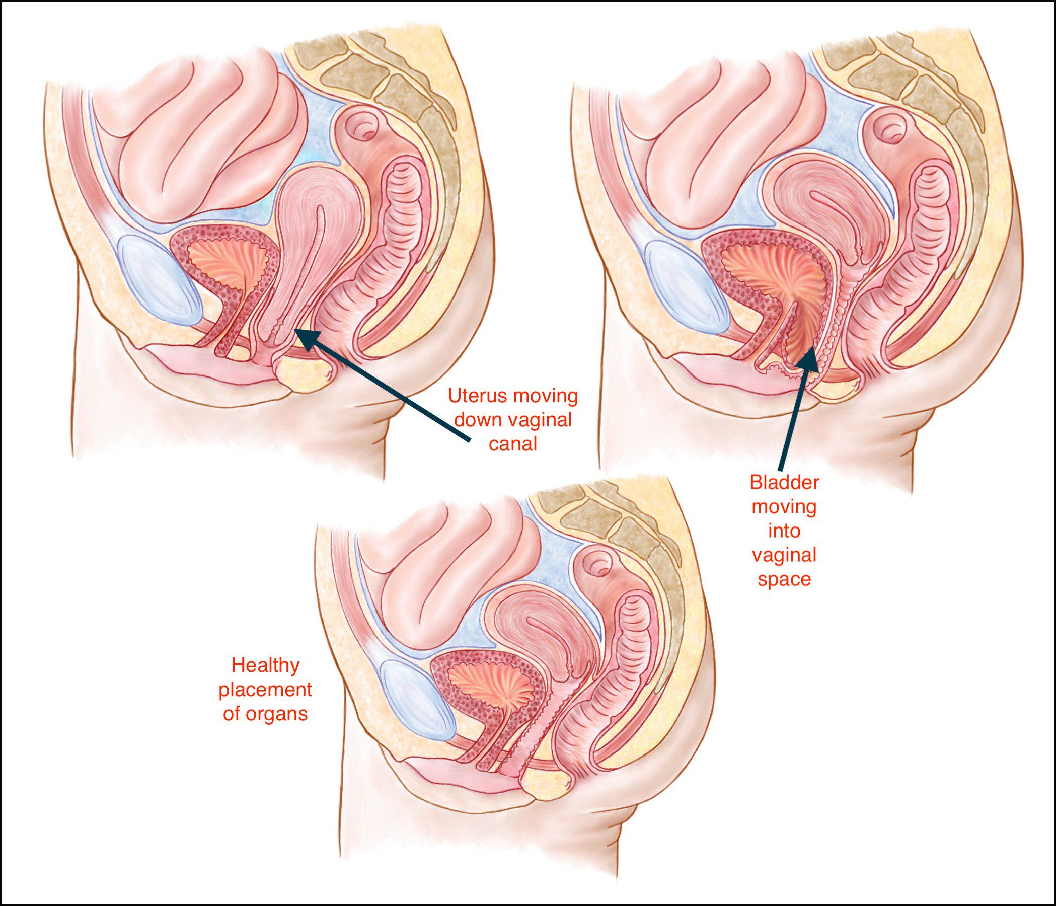 Pelvic Floor Dysfunction