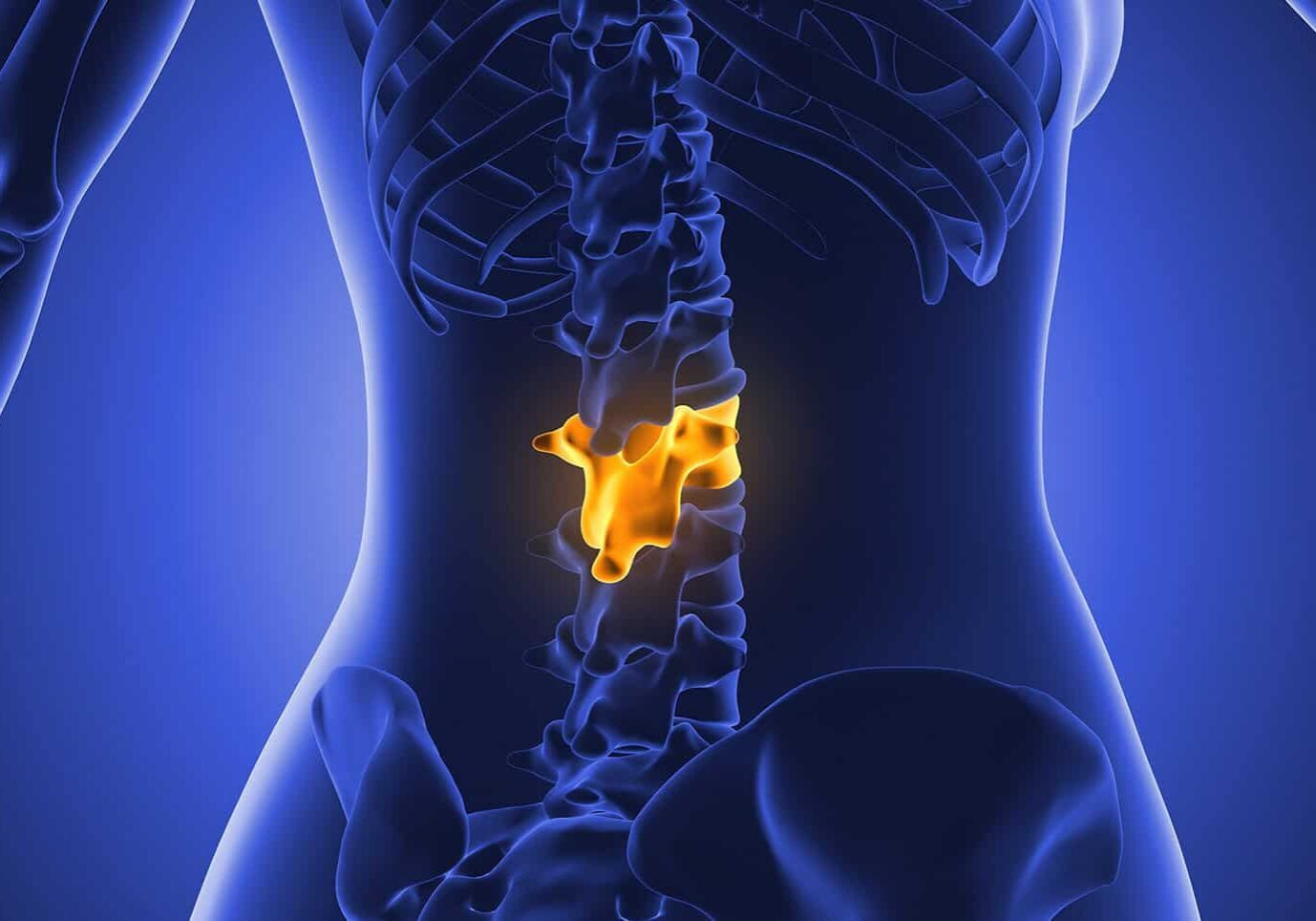 Lumbaler Bandscheibenvorfall 2