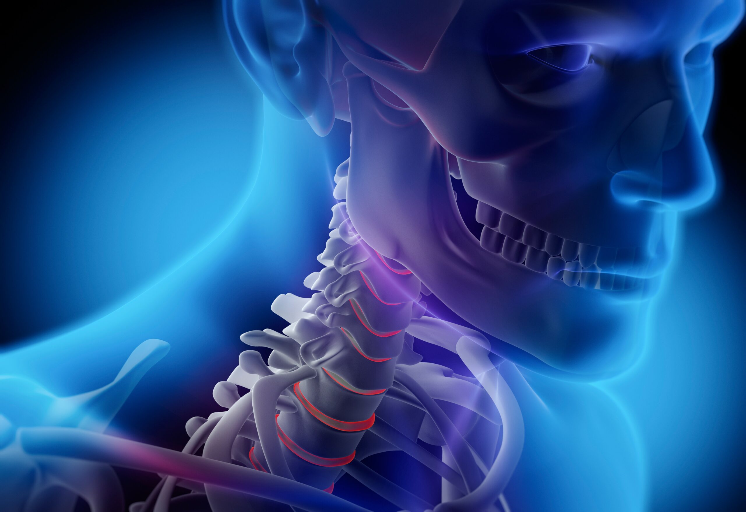 Zervikaler Bandscheibenvorfall