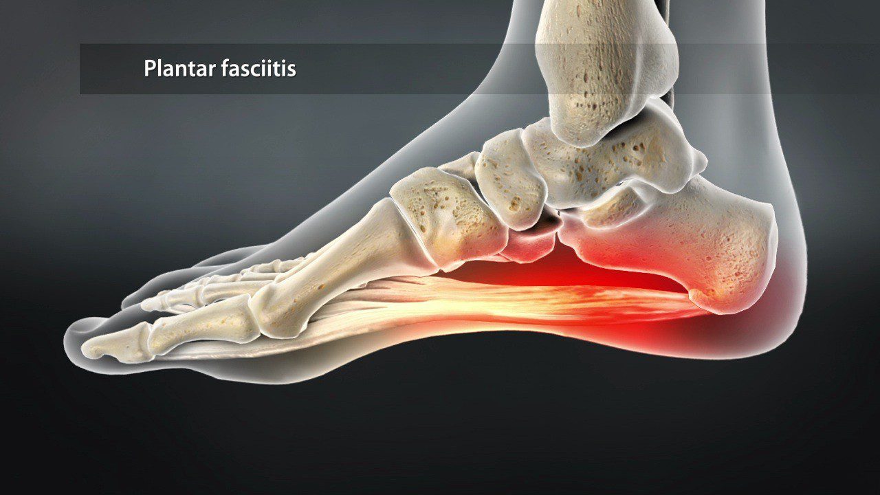 Plantarfasziitis