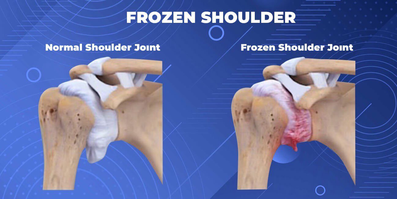 Frozen Shoulder 2