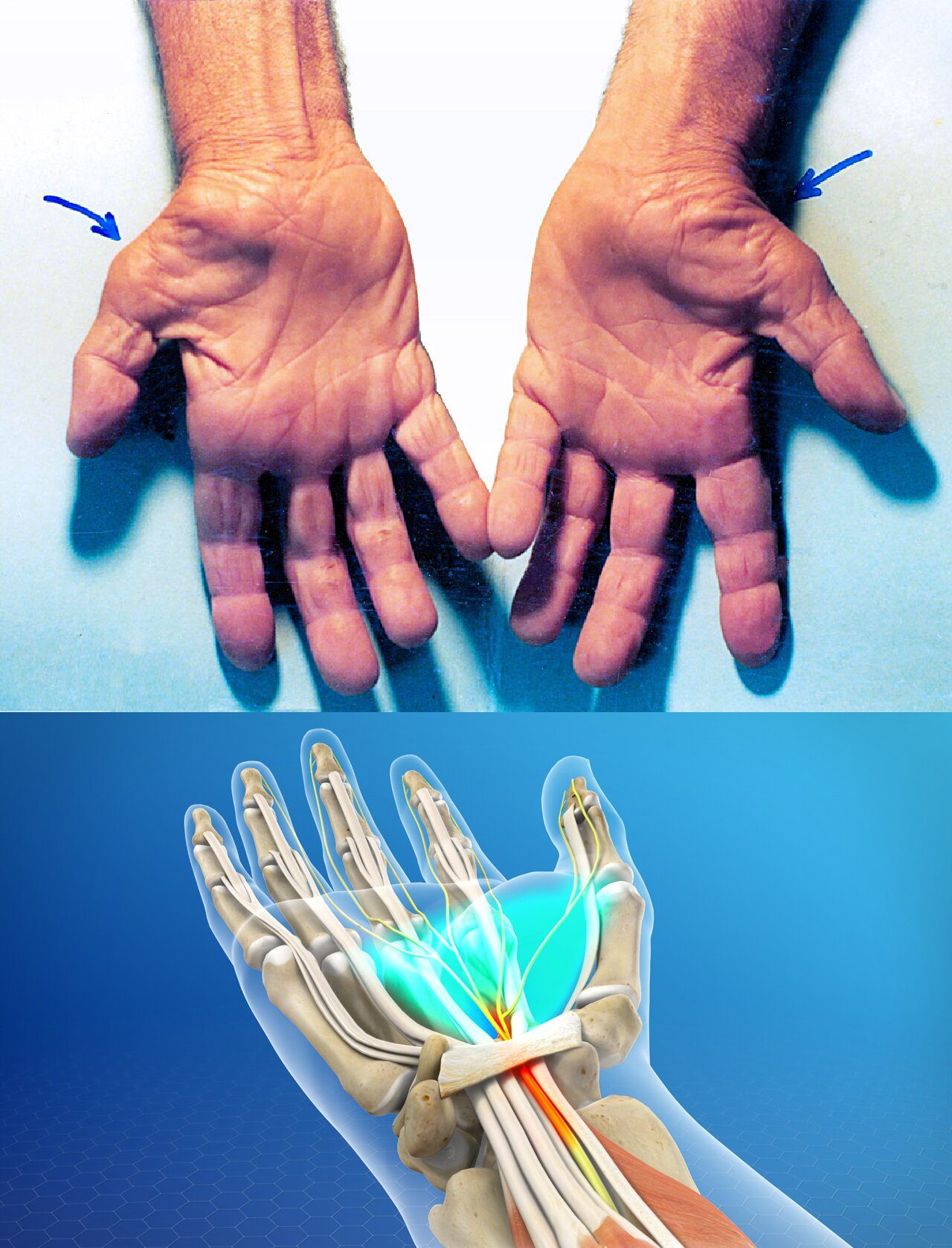Karpaltunnelsyndrom