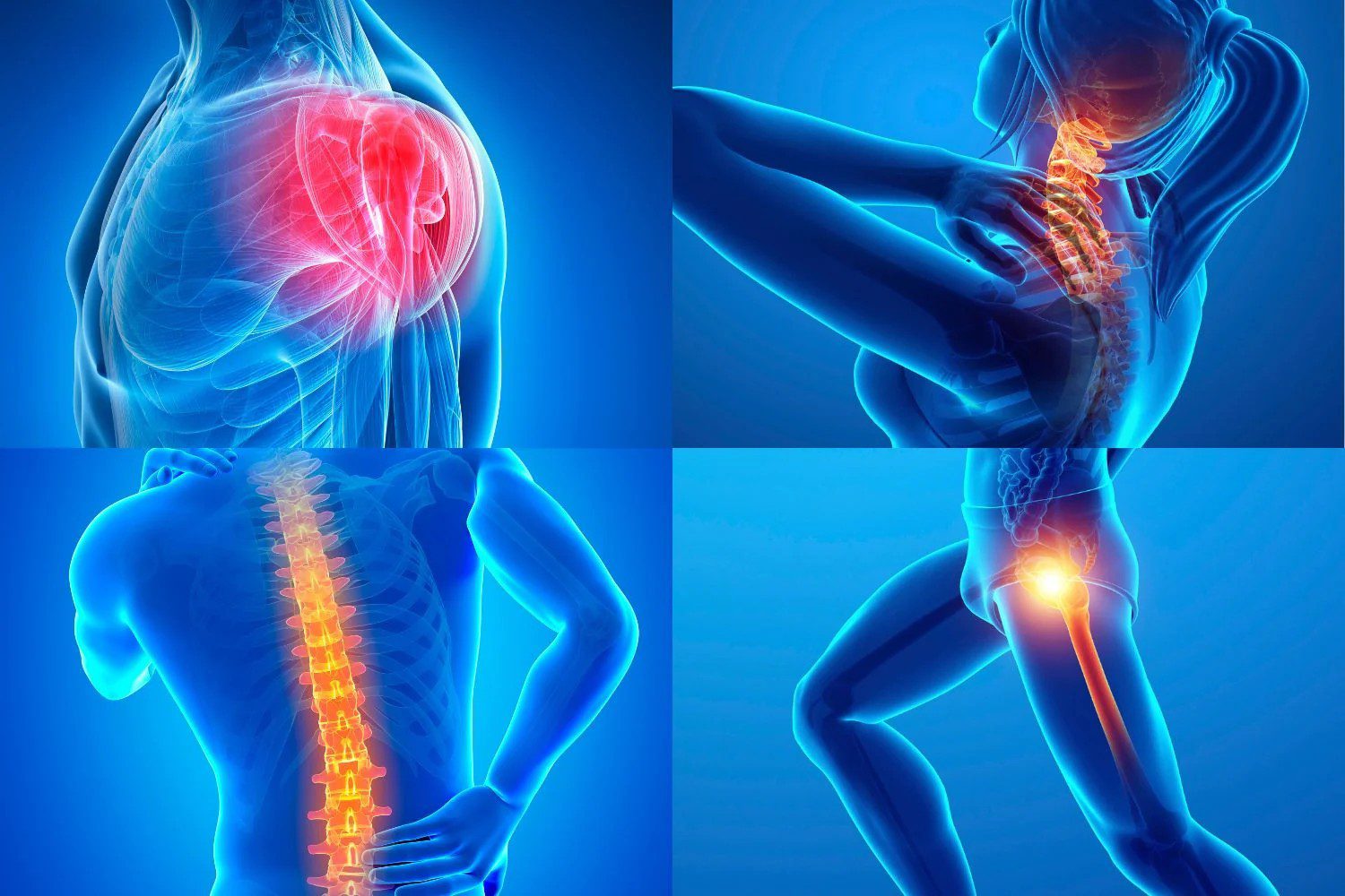 Fibromyalgie
