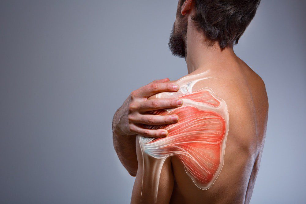 Schulterimpingement