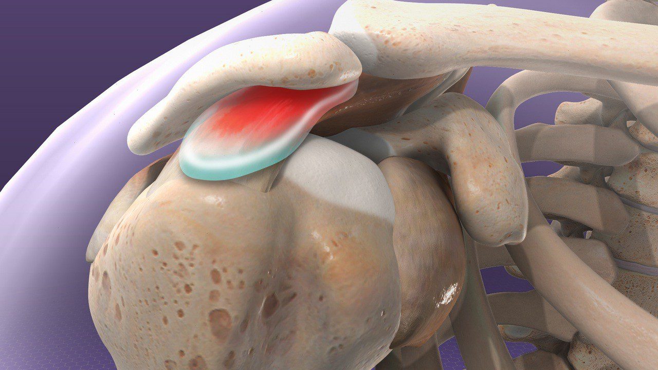 Schulterimpingement 2