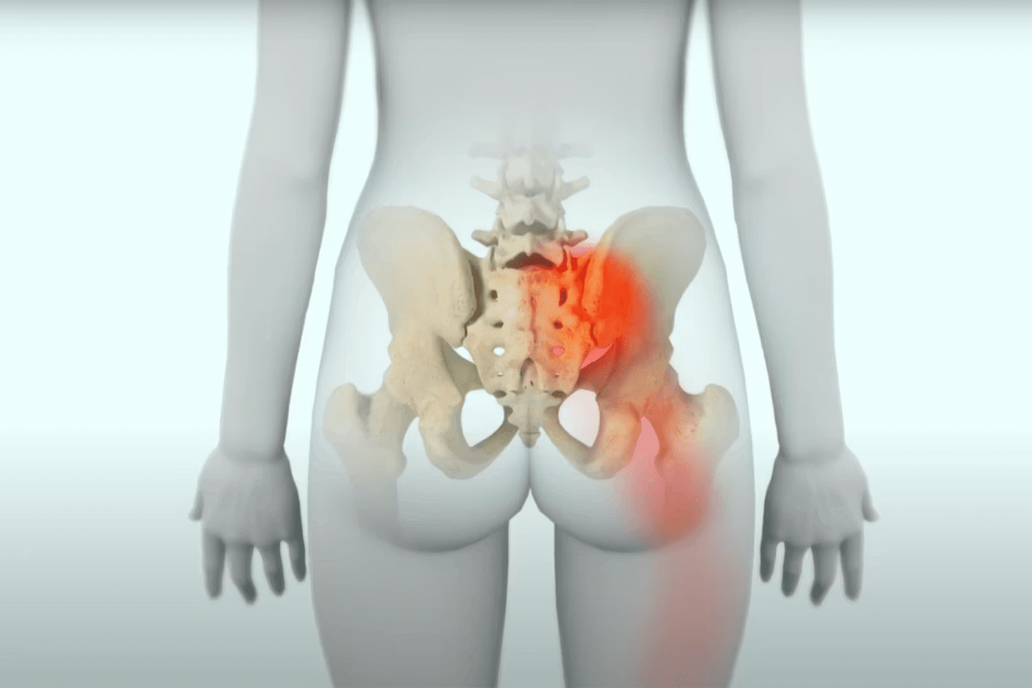 SI Joint Instability 2
